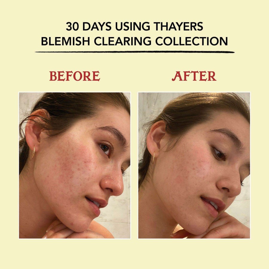 Cleansers * | Witch Hazel Blemish Clearing Toner Thayers Online Store